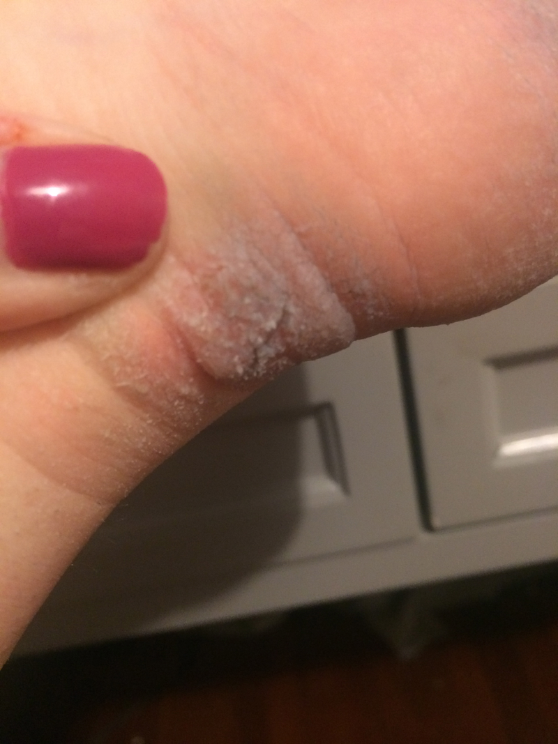 Illustration for article titled Gross Foot Skin Questions (Warning: Photos)
